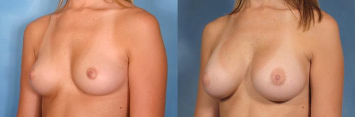 Before & After Breast Augmentation Case 119 View #2 View in Naples and Ft. Myers, FL