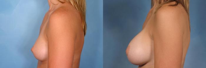 Before & After Breast Augmentation Case 119 View #3 View in Naples and Ft. Myers, FL