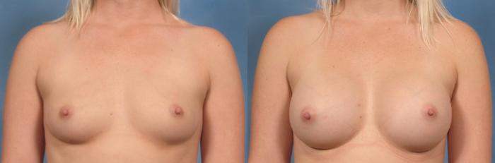 Before & After Breast Augmentation Case 121 View #1 View in Naples and Ft. Myers, FL