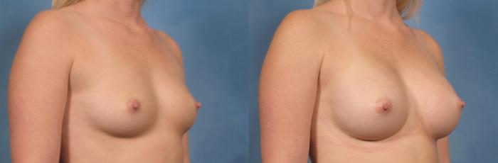 Before & After Breast Augmentation Case 121 View #2 View in Naples and Ft. Myers, FL