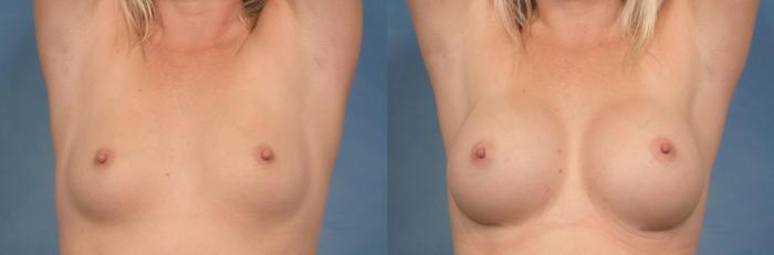 Before & After Breast Augmentation Case 121 View #4 View in Naples and Ft. Myers, FL