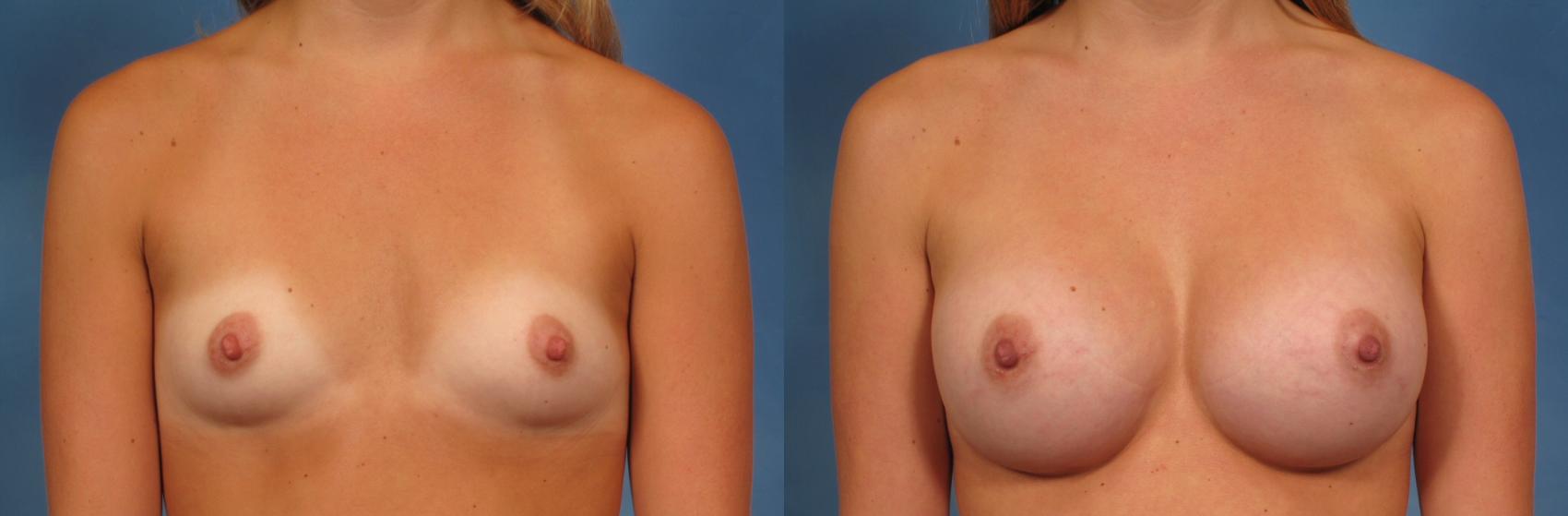 Before & After Breast Augmentation Case 144 View #1 View in Naples and Ft. Myers, FL