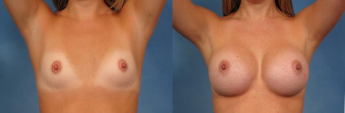 Before & After Breast Augmentation Case 144 View #2 View in Naples and Ft. Myers, FL