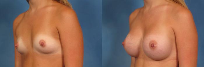 Before & After Breast Augmentation Case 144 View #3 View in Naples and Ft. Myers, FL