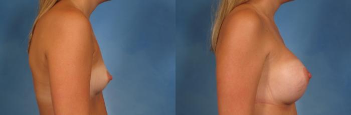 Before & After Breast Augmentation Case 144 View #4 View in Naples and Ft. Myers, FL