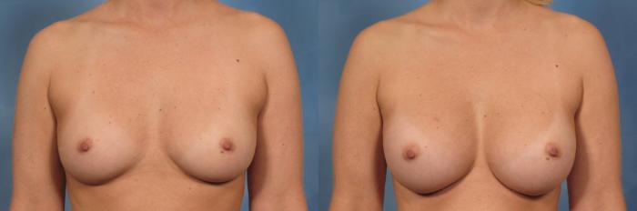 Before & After Breast Augmentation Case 157 View #1 View in Naples and Ft. Myers, FL