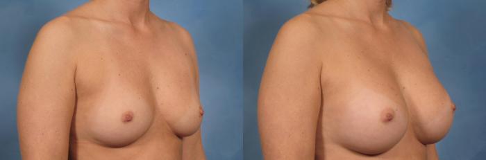 Before & After Breast Augmentation Case 157 View #2 View in Naples and Ft. Myers, FL