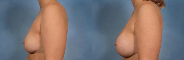 Before & After Breast Augmentation Case 157 View #3 View in Naples and Ft. Myers, FL