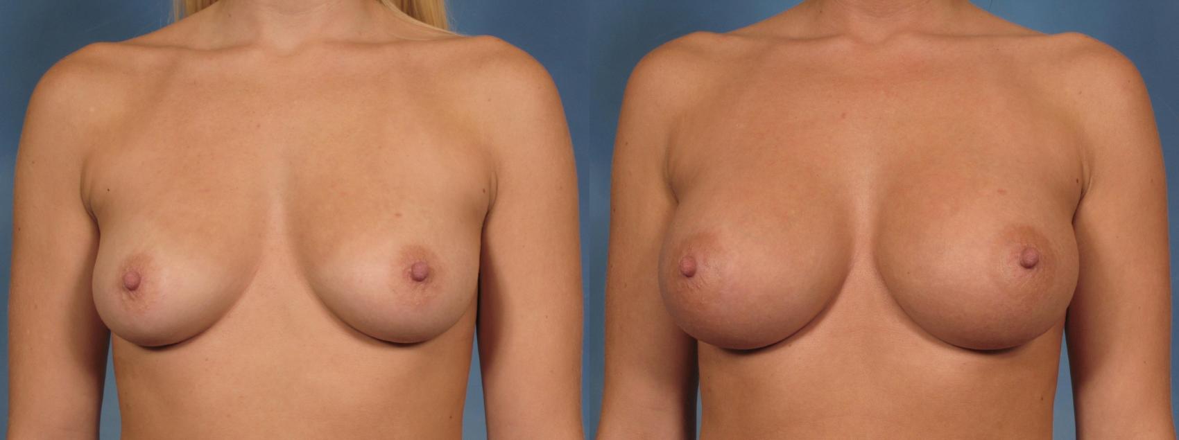 Before & After Breast Augmentation Case 158 View #1 View in Naples and Ft. Myers, FL