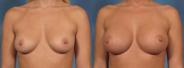 Before & After Breast Augmentation Case 158 View #1 View in Naples and Ft. Myers, FL