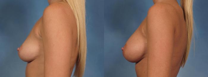 Before & After Breast Augmentation Case 158 View #4 View in Naples and Ft. Myers, FL