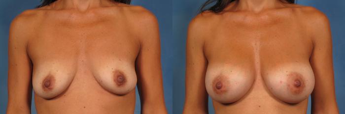 Before & After Breast Augmentation Case 159 View #1 View in Naples and Ft. Myers, FL