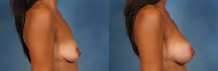 Before & After Breast Augmentation Case 159 View #3 View in Naples and Ft. Myers, FL