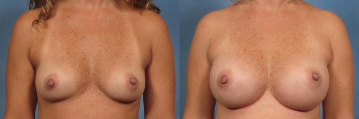 Before & After Breast Augmentation Case 160 View #1 View in Naples and Ft. Myers, FL