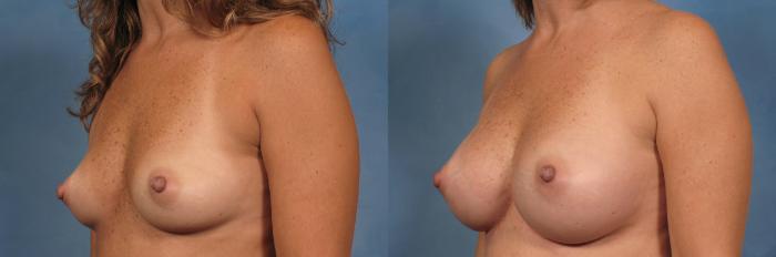 Before & After Breast Augmentation Case 160 View #2 View in Naples and Ft. Myers, FL