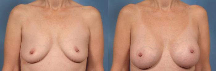 Before & After Breast Augmentation Case 162 View #1 View in Naples and Ft. Myers, FL