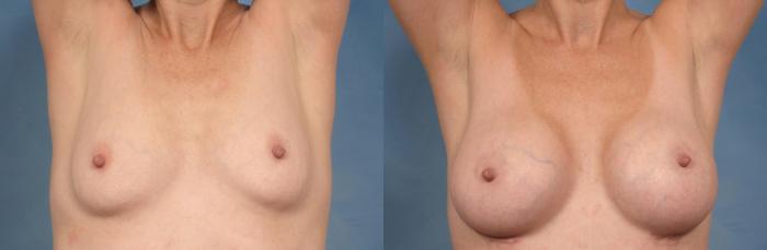 Before & After Breast Augmentation Case 162 View #2 View in Naples and Ft. Myers, FL
