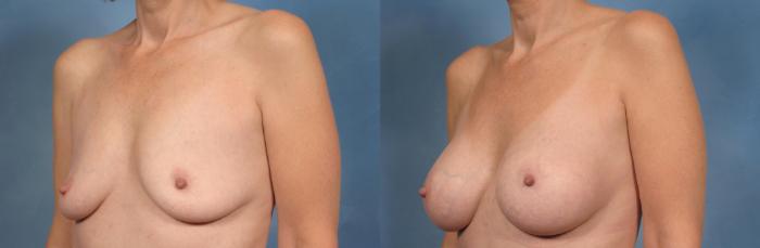 Before & After Breast Augmentation Case 162 View #3 View in Naples and Ft. Myers, FL