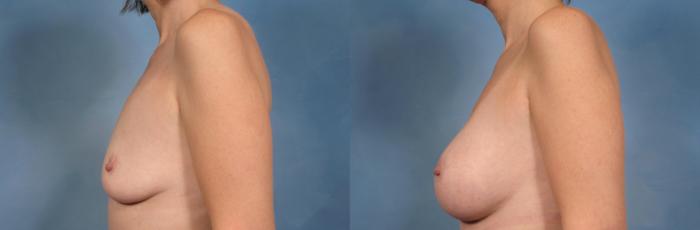 Before & After Breast Augmentation Case 162 View #4 View in Naples and Ft. Myers, FL