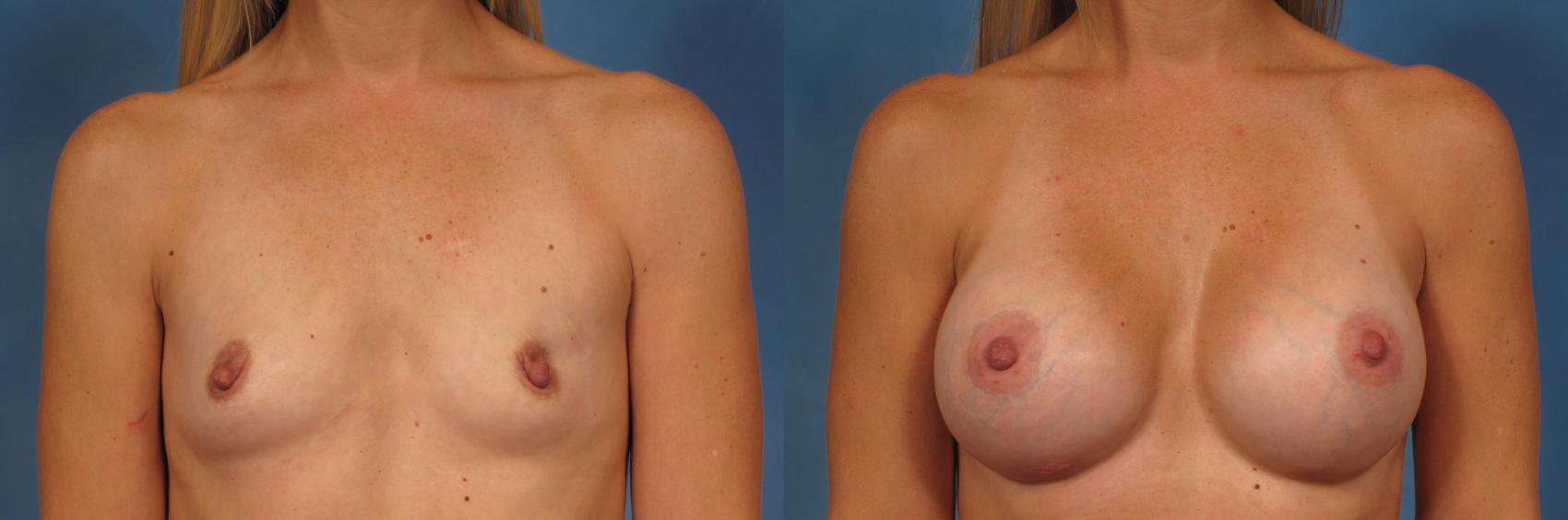 Before & After Breast Augmentation Case 196 View #1 View in Naples and Ft. Myers, FL