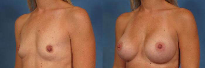 Before & After Breast Augmentation Case 196 View #2 View in Naples and Ft. Myers, FL
