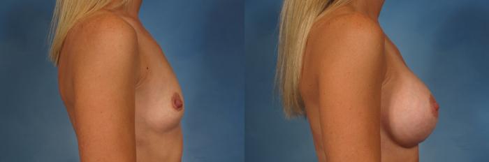 Before & After Breast Augmentation Case 196 View #3 View in Naples and Ft. Myers, FL