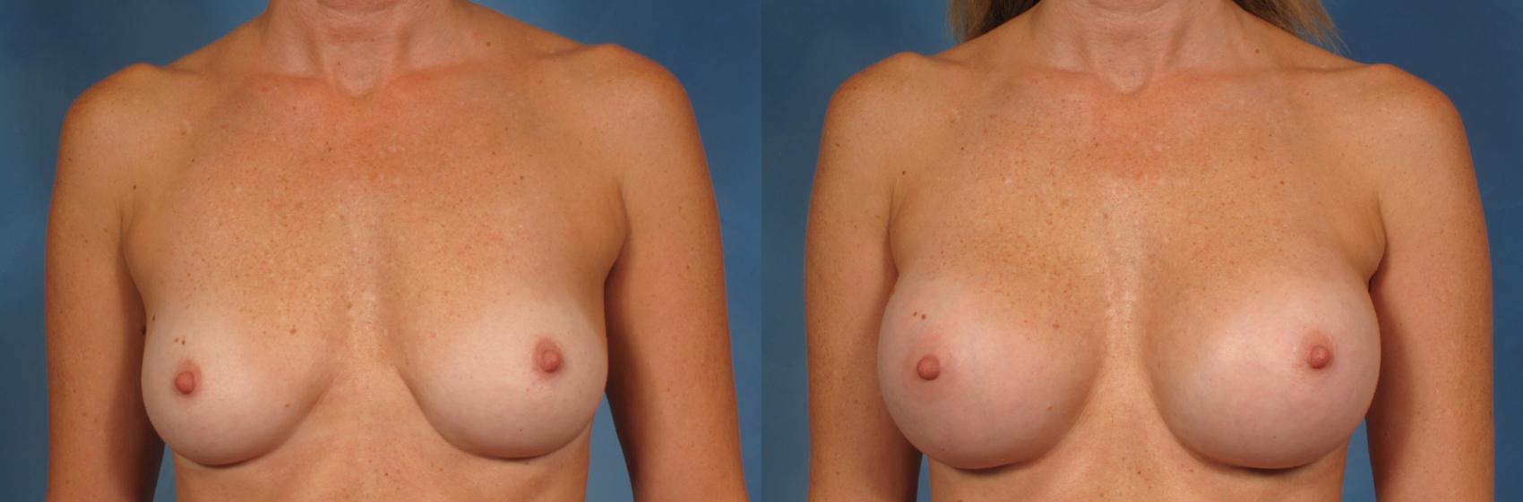 Before & After Breast Augmentation Case 197 View #1 View in Naples and Ft. Myers, FL