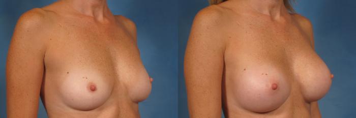 Before & After Breast Augmentation Case 197 View #3 View in Naples and Ft. Myers, FL