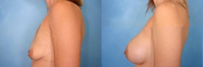 Before & After Breast Augmentation Case 2 View #1 View in Naples and Ft. Myers, FL