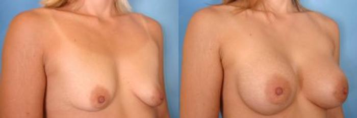 Before & After Breast Augmentation Case 2 View #2 View in Naples and Ft. Myers, FL