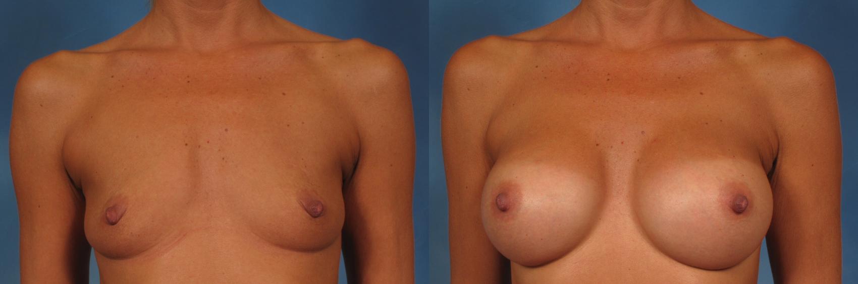 Before & After Breast Augmentation Case 205 View #1 View in Naples and Ft. Myers, FL