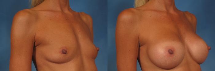 Before & After Breast Augmentation Case 205 View #2 View in Naples and Ft. Myers, FL