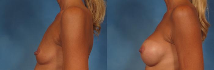 Before & After Breast Augmentation Case 205 View #3 View in Naples and Ft. Myers, FL