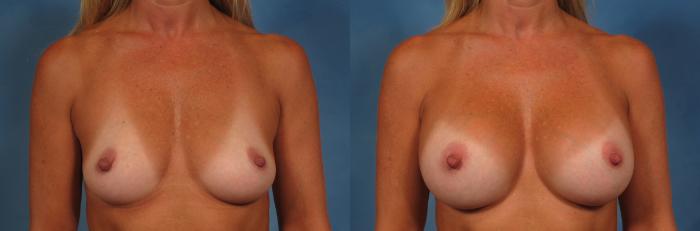 Before & After Breast Augmentation Case 206 View #1 View in Naples and Ft. Myers, FL