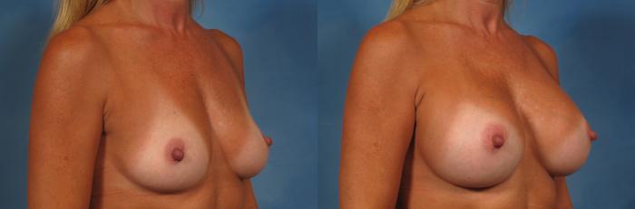 Before & After Breast Augmentation Case 206 View #2 View in Naples and Ft. Myers, FL