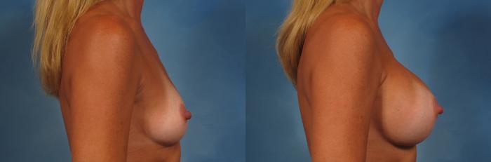 Before & After Breast Augmentation Case 206 View #3 View in Naples and Ft. Myers, FL