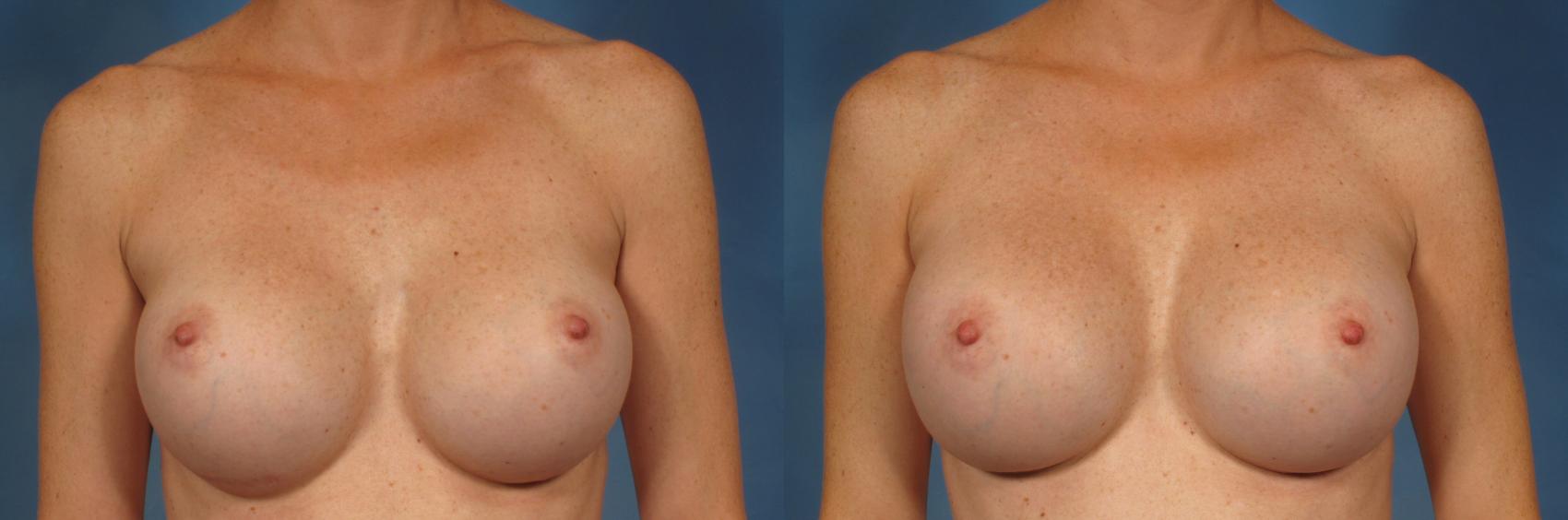 Before & After Breast Augmentation Case 228 View #1 View in Naples, FL