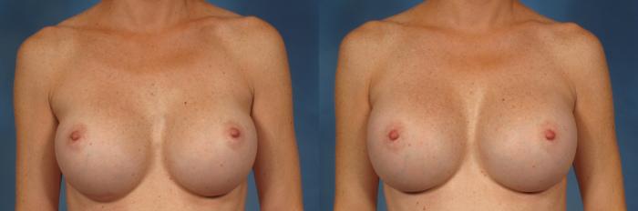 Before & After Breast Augmentation Case 228 View #1 View in Naples and Ft. Myers, FL