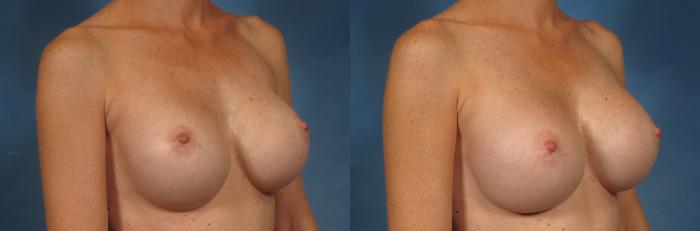 Before & After Breast Augmentation Case 228 View #2 View in Naples and Ft. Myers, FL