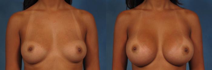 Before & After Breast Augmentation Case 233 View #4 View in Naples and Ft. Myers, FL