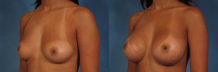 Before & After Breast Augmentation Case 233 View #5 View in Naples and Ft. Myers, FL