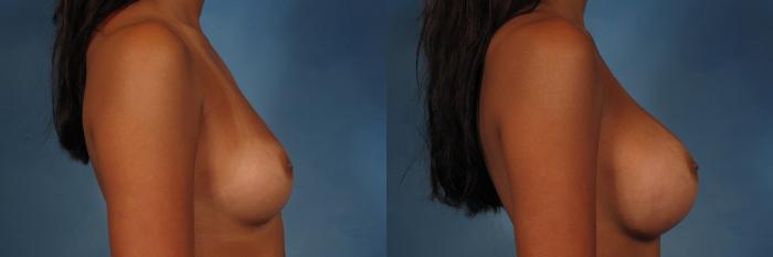 Before & After Breast Augmentation Case 233 View #6 View in Naples and Ft. Myers, FL