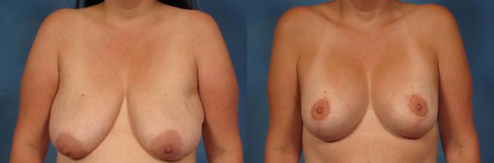 Before & After Breast Augmentation Case 240 View #1 View in Naples and Ft. Myers, FL