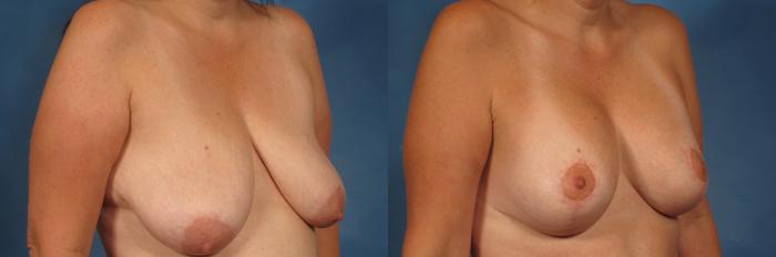 Before & After Breast Augmentation Case 240 View #3 View in Naples and Ft. Myers, FL