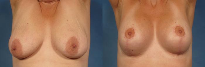 Before & After Breast Augmentation Case 240 View #4 View in Naples and Ft. Myers, FL