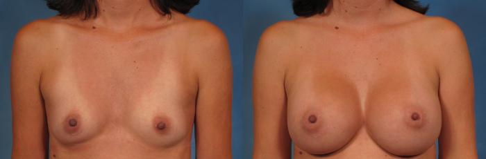 Before & After Breast Augmentation Case 249 View #1 View in Naples and Ft. Myers, FL