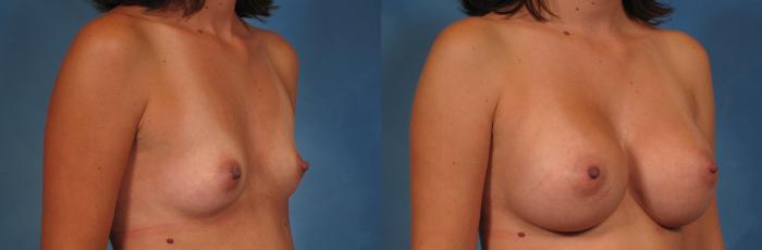 Before & After Breast Augmentation Case 249 View #2 View in Naples and Ft. Myers, FL