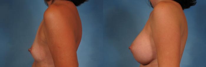 Before & After Breast Augmentation Case 249 View #3 View in Naples and Ft. Myers, FL