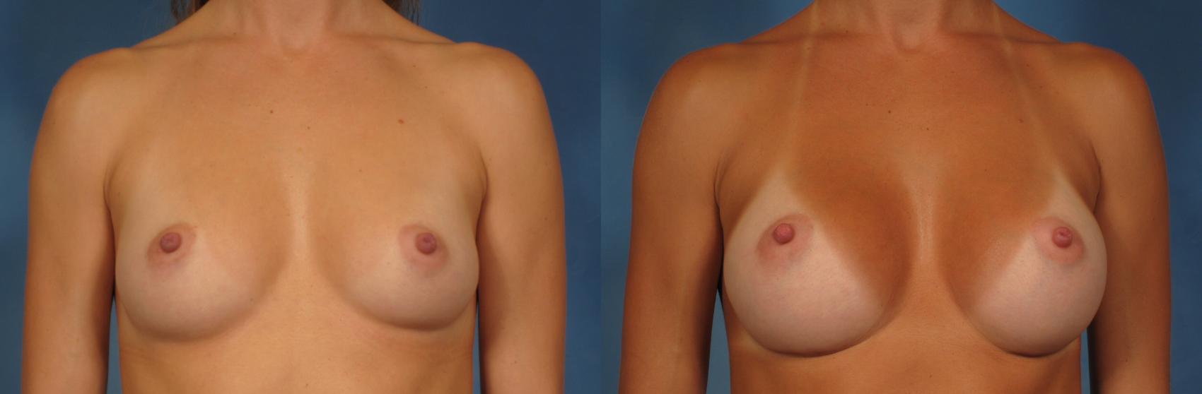 Before & After Breast Augmentation Case 250 View #1 View in Naples and Ft. Myers, FL