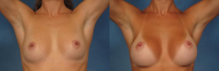Before & After Breast Augmentation Case 250 View #2 View in Naples and Ft. Myers, FL